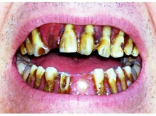 Dental Distortion tenner - Dead Zed